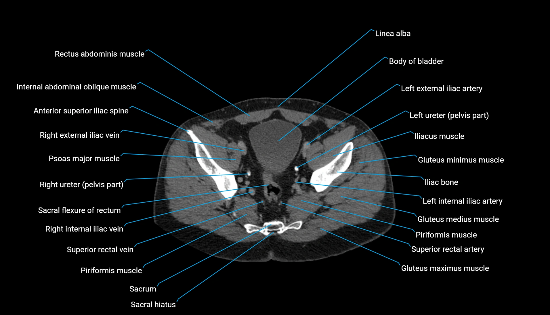CT urogram axial cross sectional anatomy  labelled radiology image-00205.webp